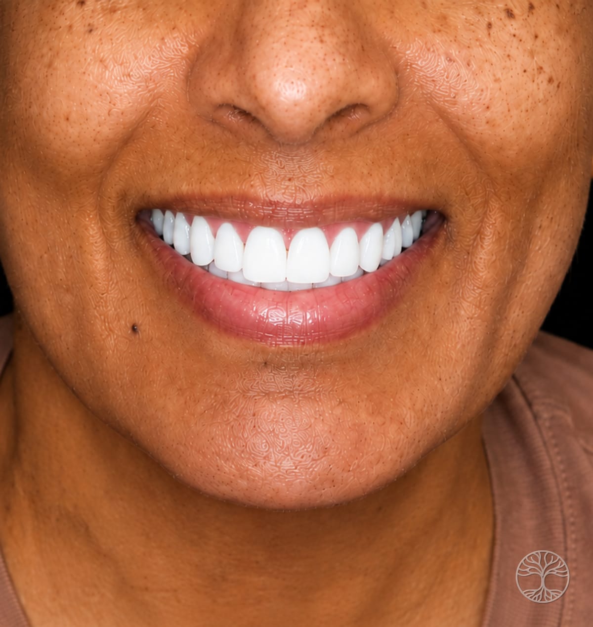 Full-arch dental implant smile restoration — after