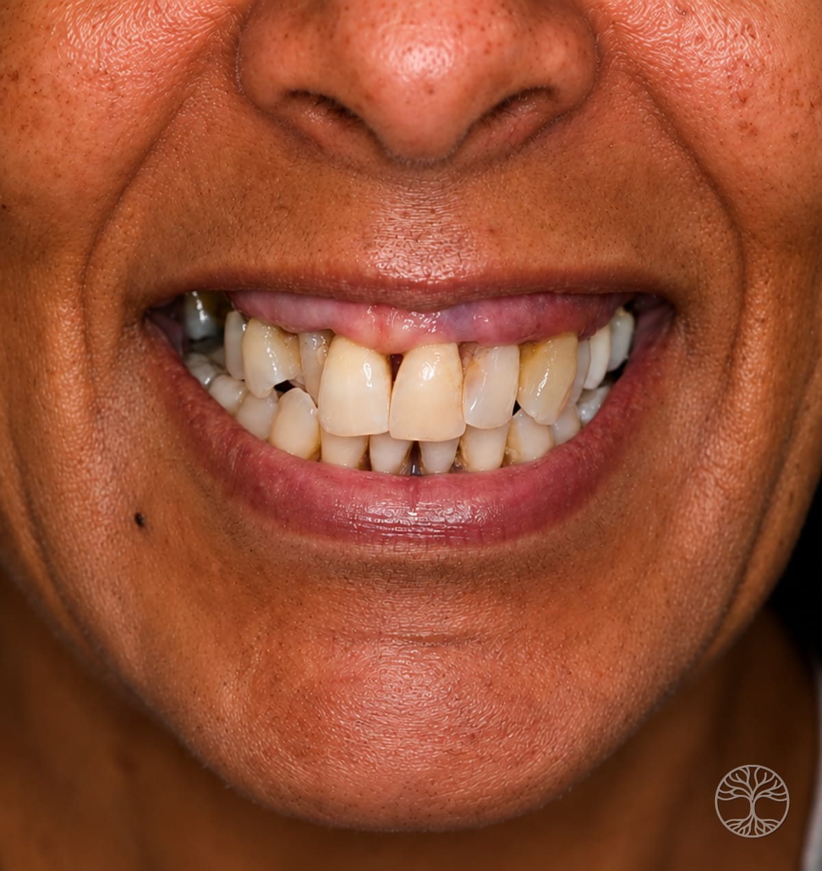 Full-arch dental implant smile restoration — before