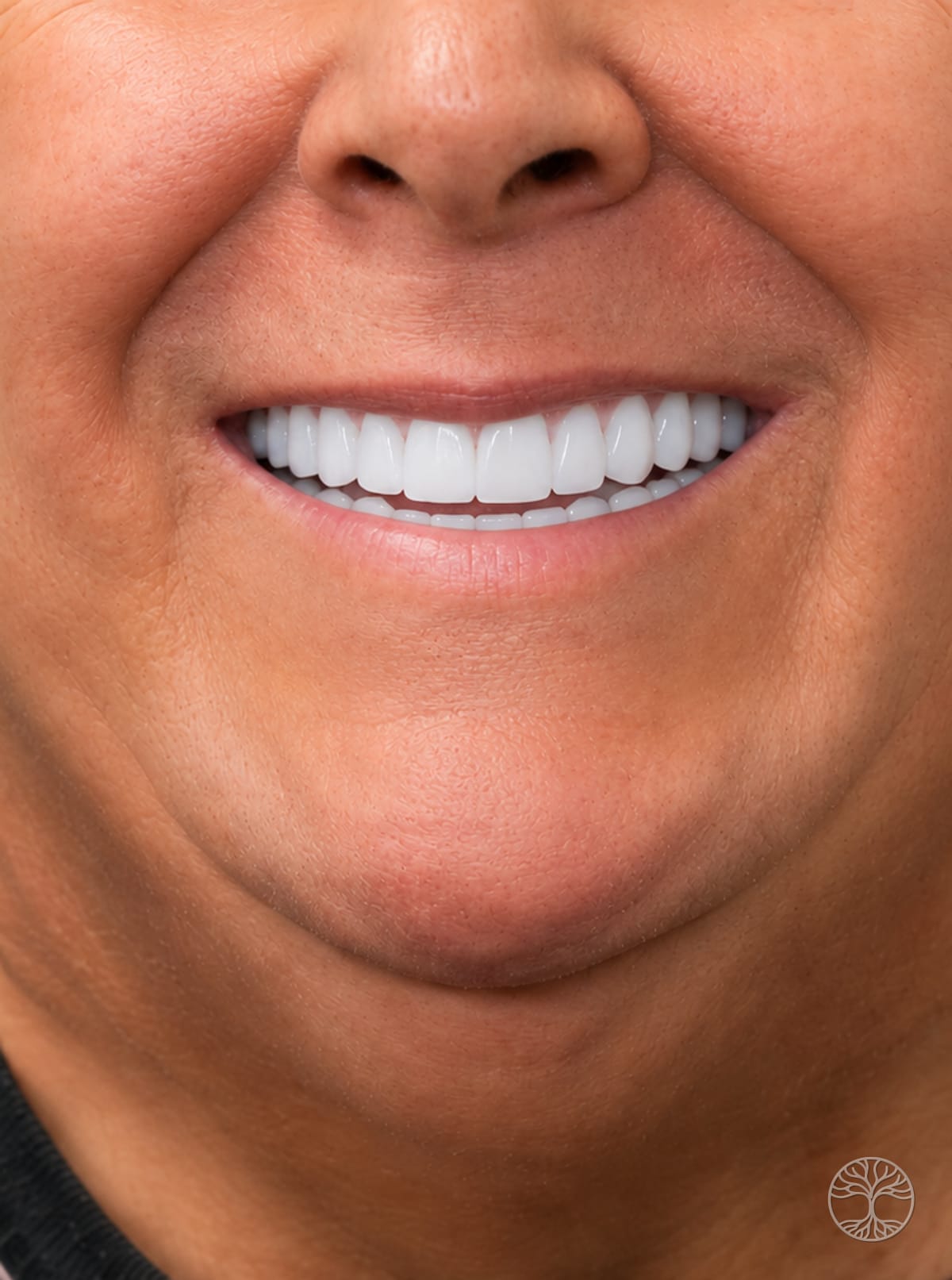 Full-arch dental implant smile restoration — after