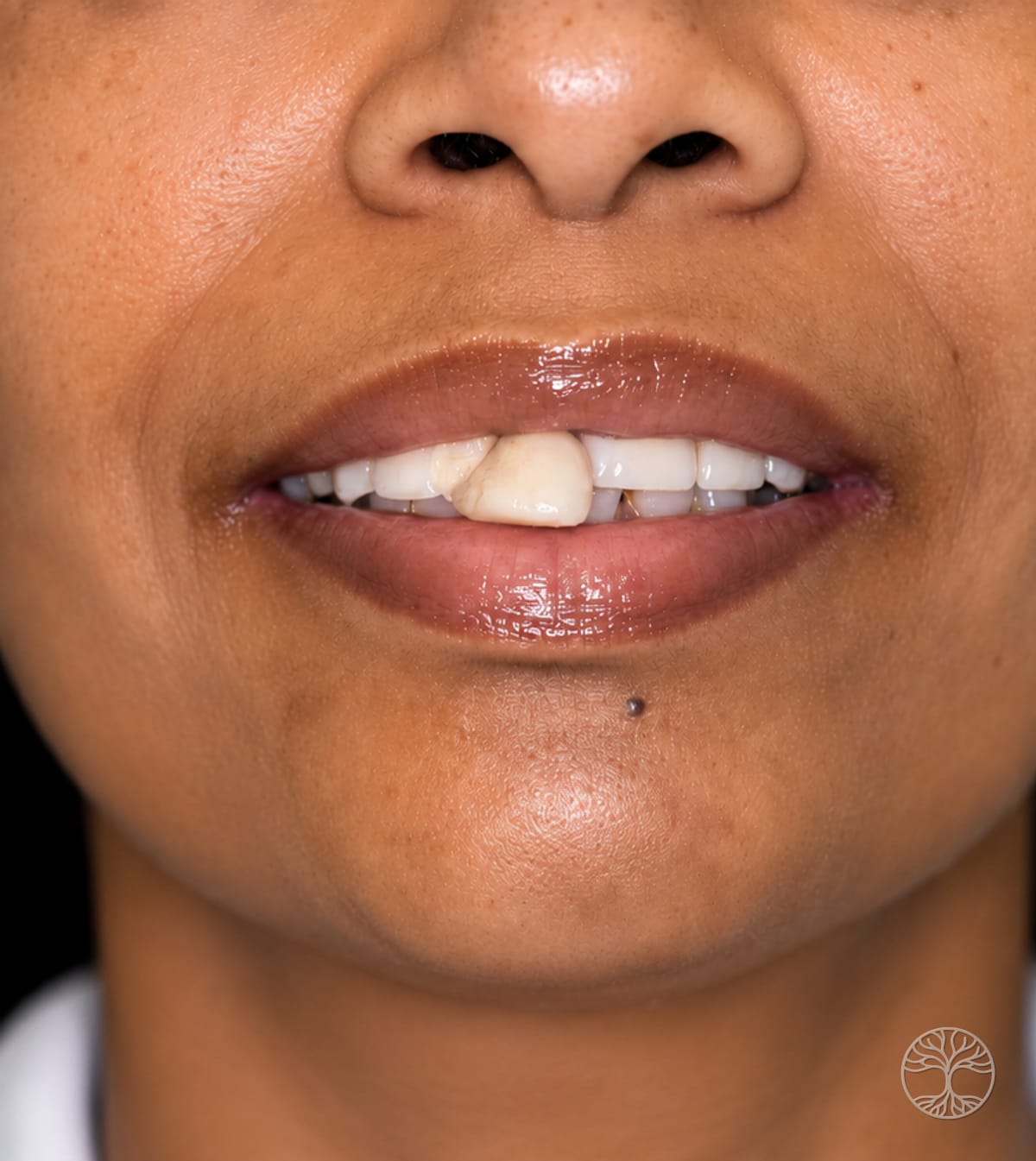 Full-arch dental implant smile restoration — before